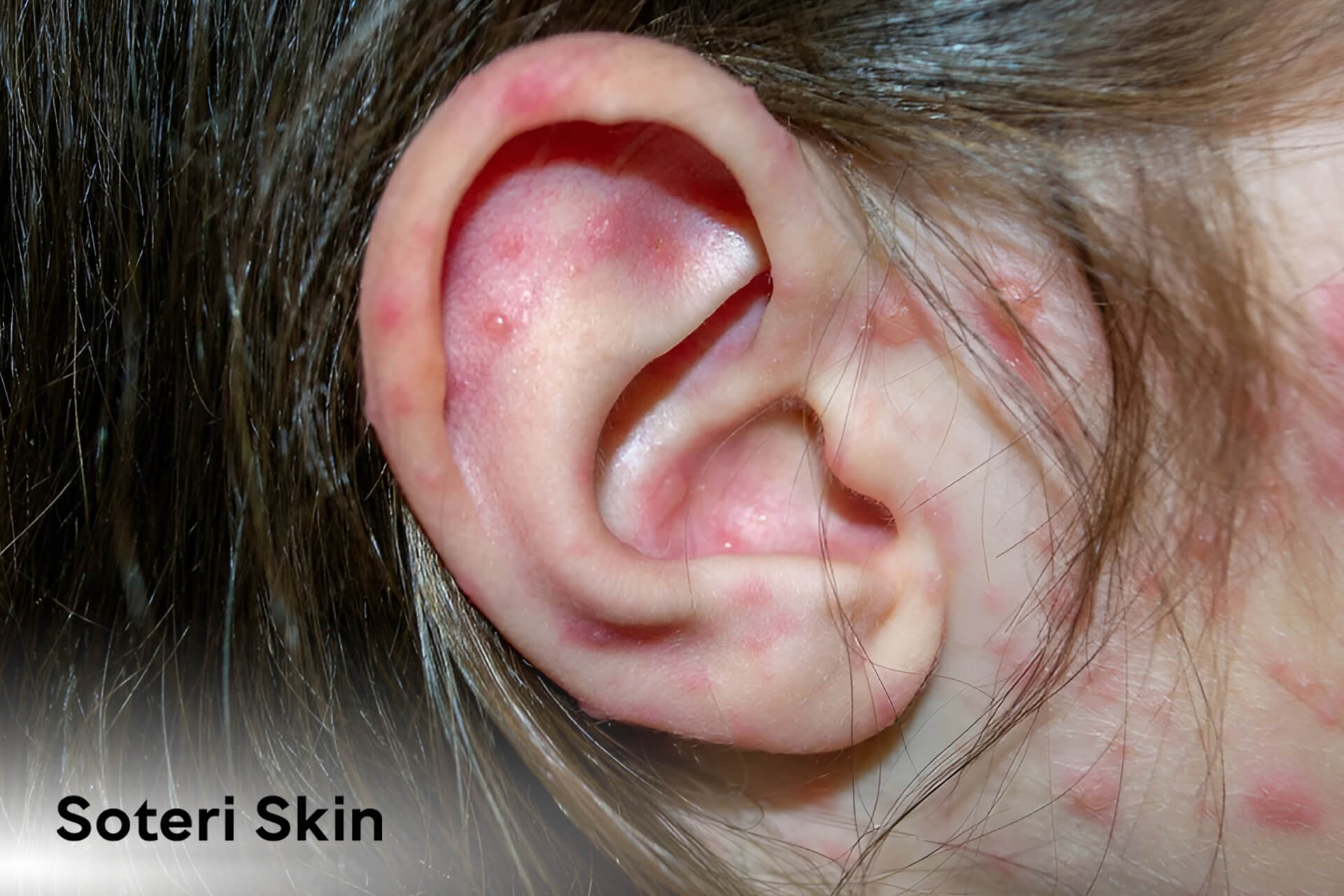 Understanding Ear Eczema: Causes, Symptoms, and Treatments