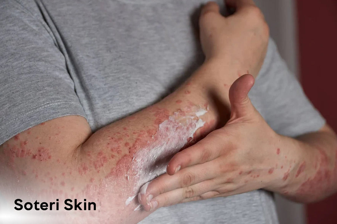 Not All Clothes Are Skin-Friendly: Watch Out for Textile Dermatitis