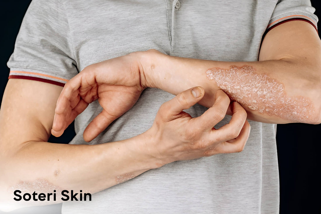 Is it Eczema or Psoriasis? Understanding the Difference