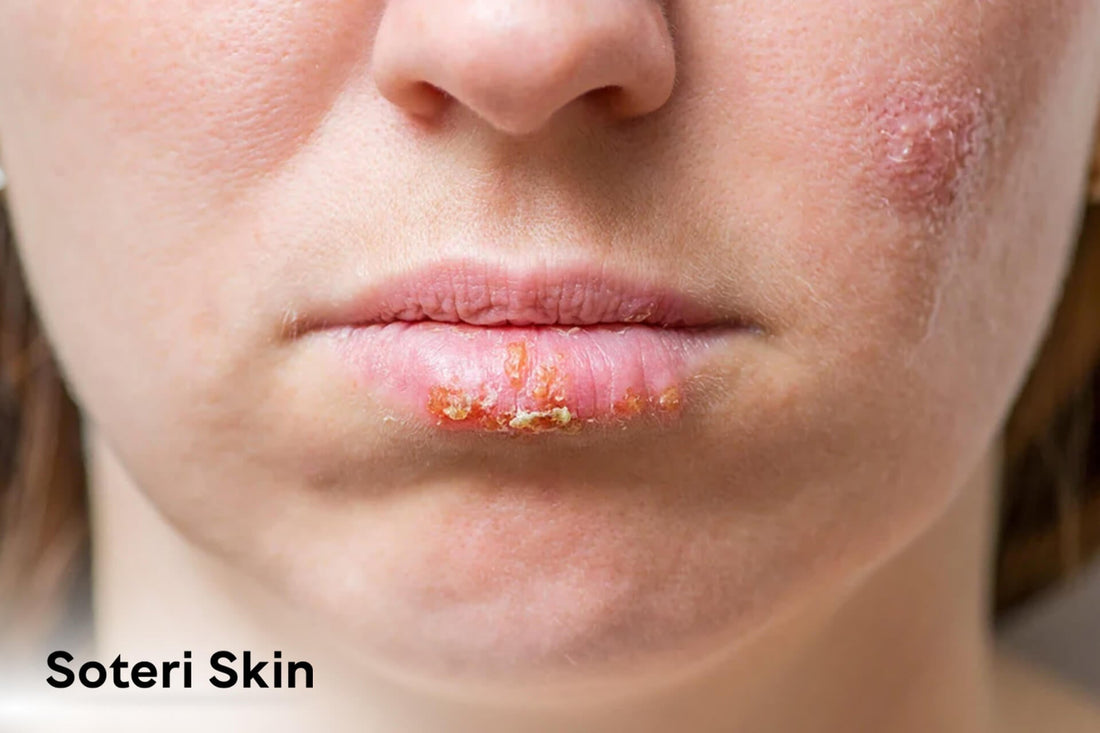Eczema on Lips: Comprehensive Guide to Understand & Treat Lip Eczema