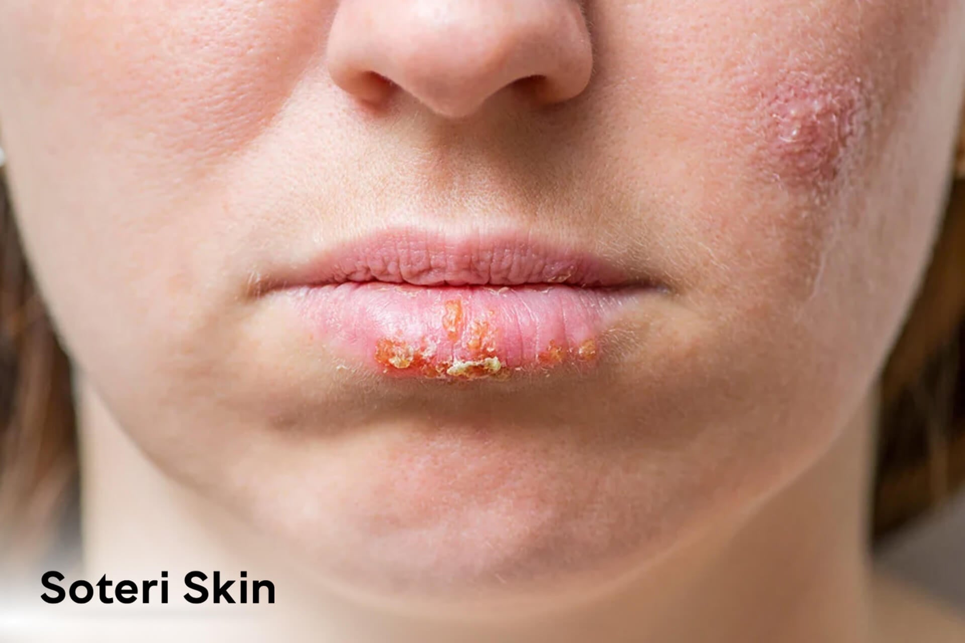 Eczema on Lips: Comprehensive Guide to Understand & Treat Lip Eczema