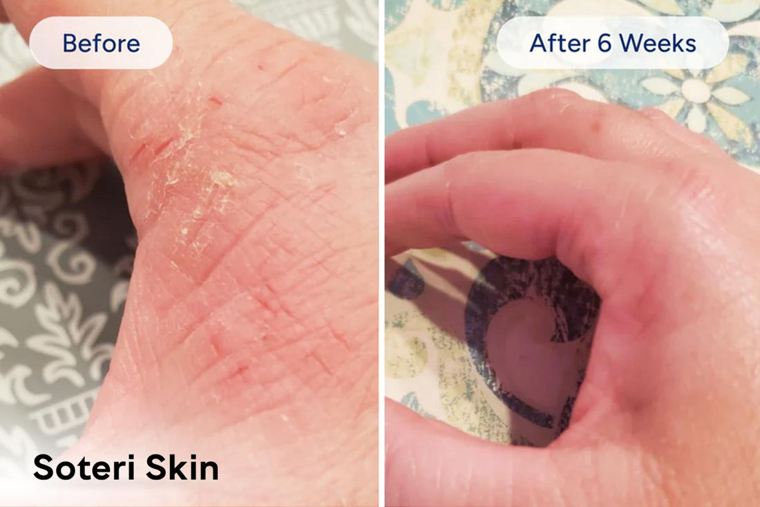 4 Reasons Soteri Skin Is the Best Eczema Cream You’ll Ever Use