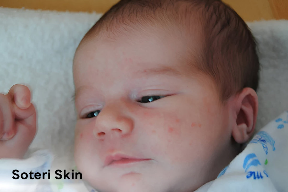 Baby Acne Treatment Guide for Parents: From Causes to Care