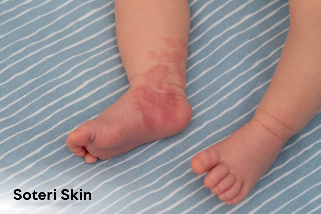 Baby Eczema VS Baby Acne: Key Differences, Symptoms & Triggers