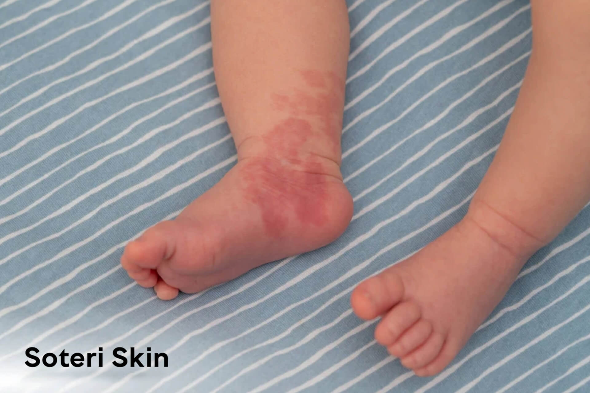 Baby Eczema VS Baby Acne: Key Differences, Symptoms & Triggers