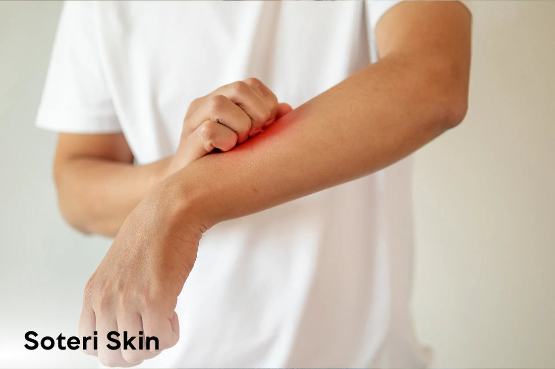 Filaggrin: The Protein Your Eczema Skin May Be Missing