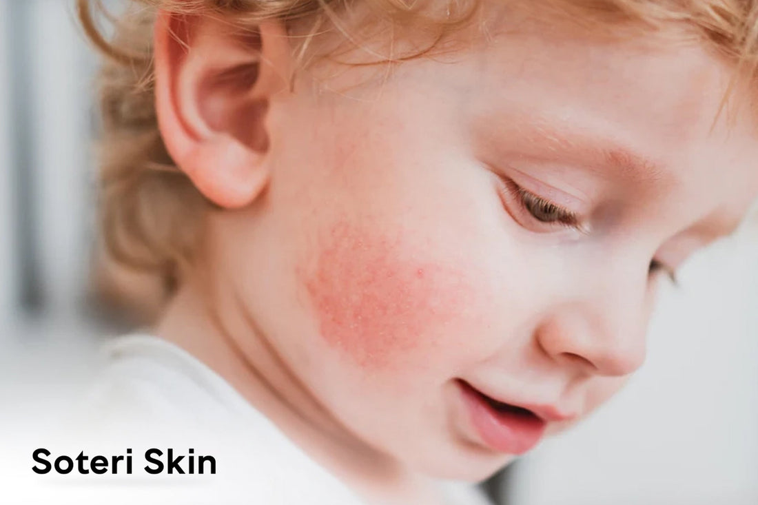Common Skin Rashes in Children: Causes, Symptoms, and Care