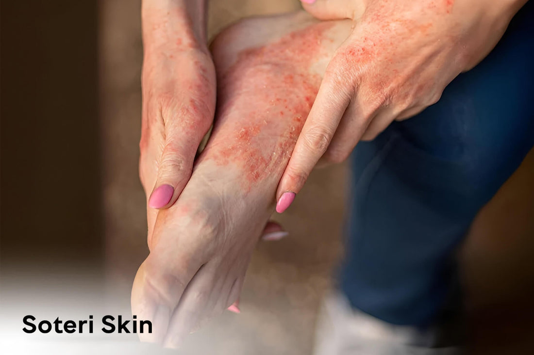 Understanding Eczema Types: Symptoms, Causes, and Treatment