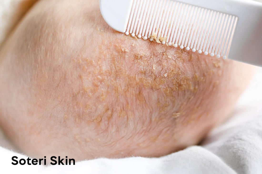 Cradle Cap in Babies: Symptoms, Stages, and Care