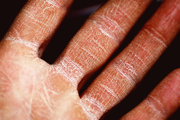 cracked skin on fingers