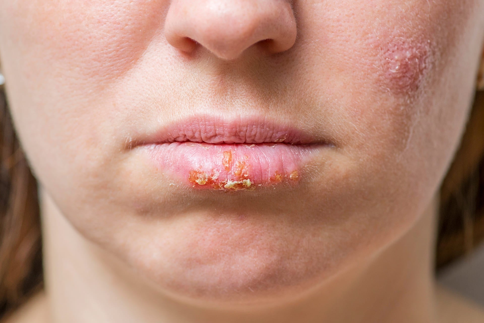 Lip Eczema: Symptoms, Causes & Relief Tips - Soteri Skin