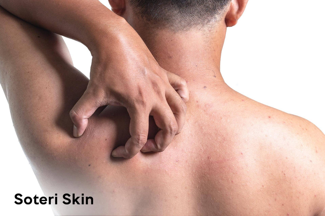 Itching After Shower and Common Triggers