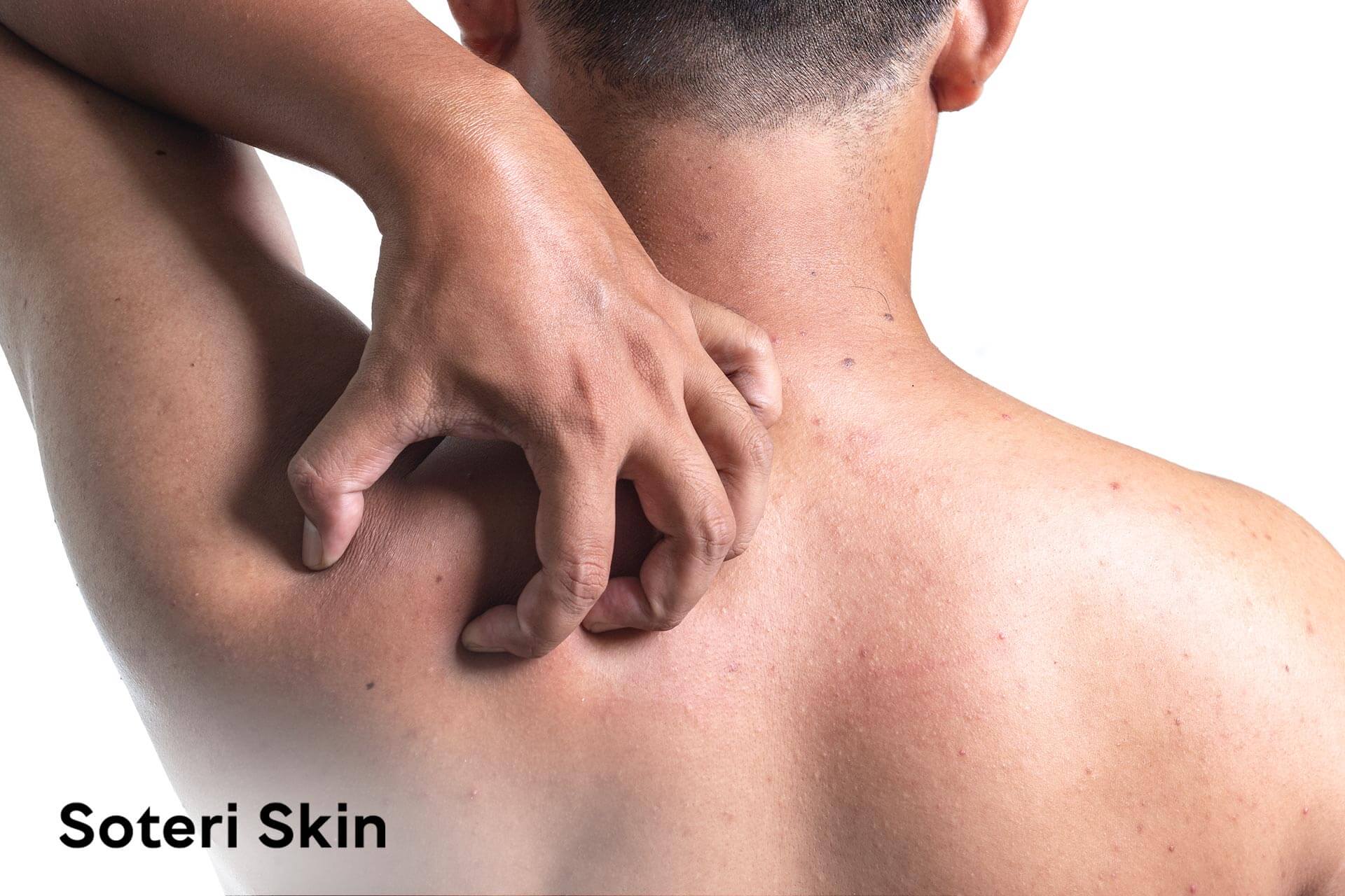 Itching After Shower and Common Triggers