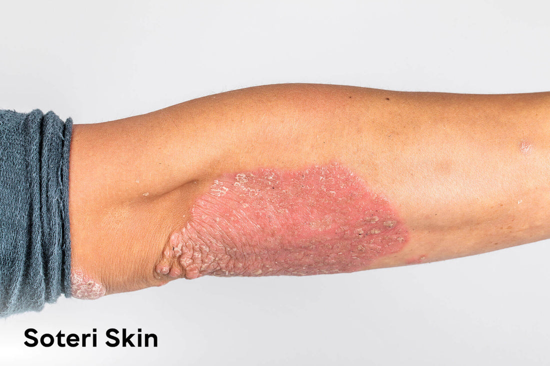 Medical Understanding of Psoriasis as a Chronic Skin Condition