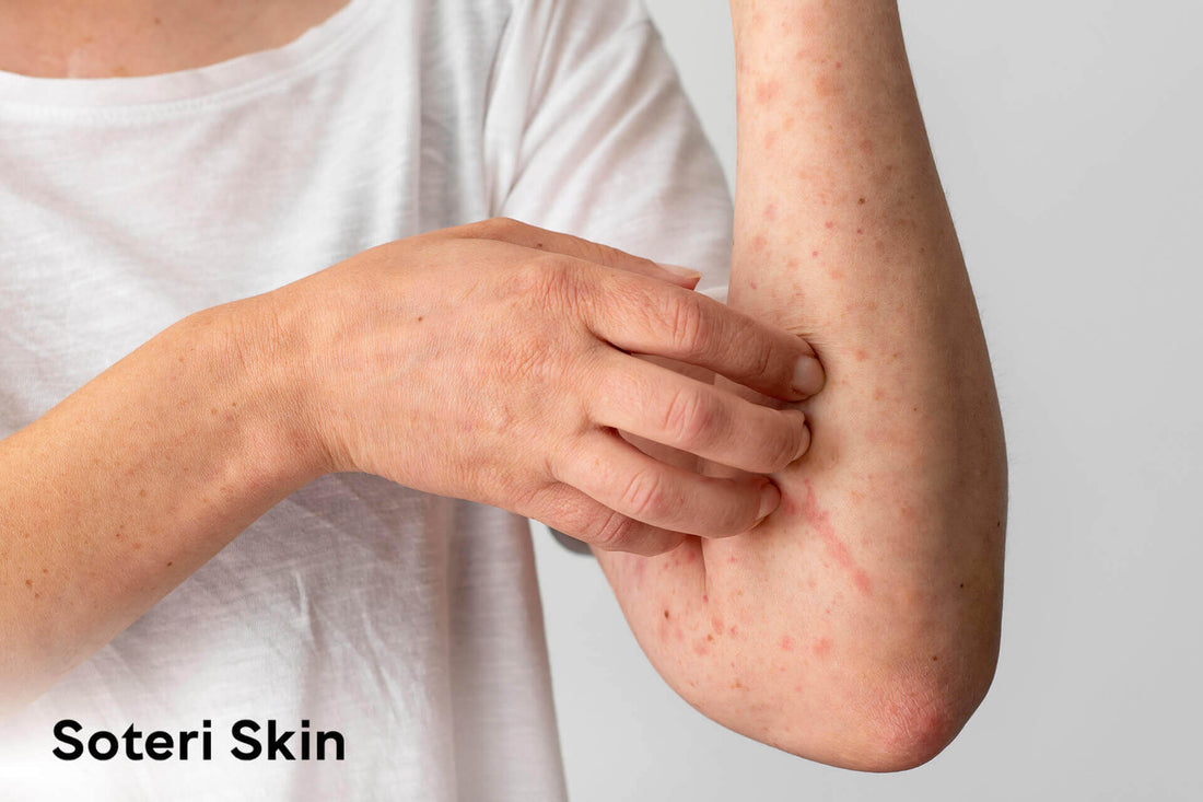 Nickel Allergy: Symptoms, Rashes, and Sensitivity Reactions