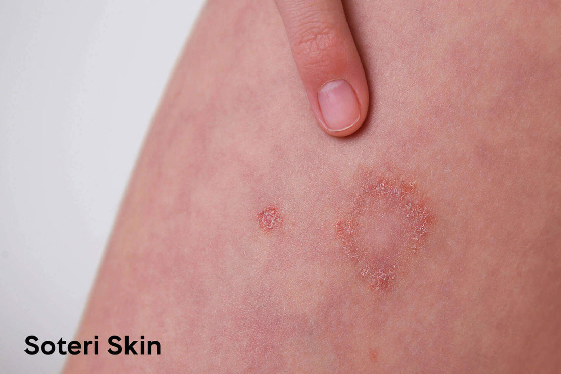 Nummular Eczema in Children: Symptoms, Signs, and Care