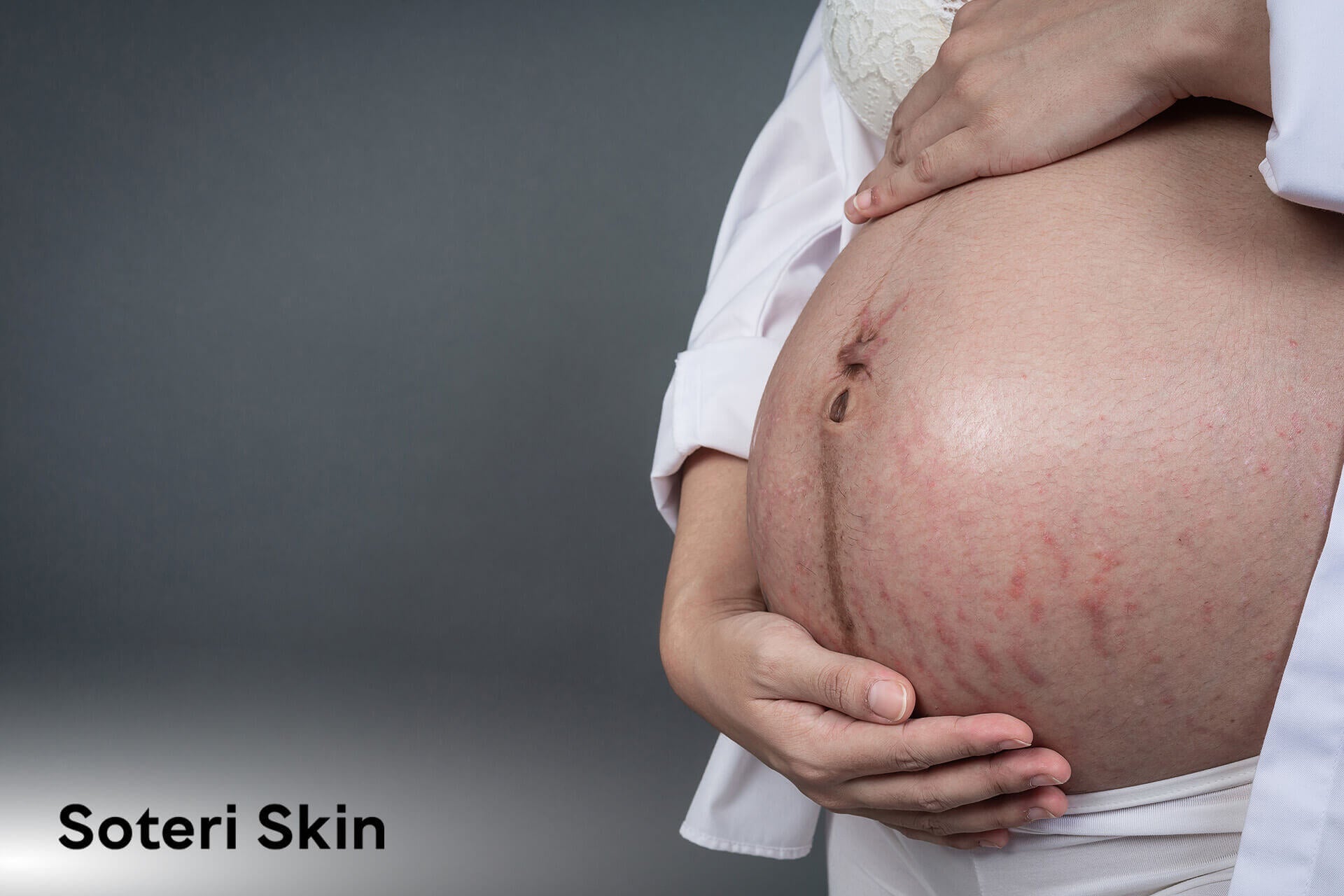 Pregnancy Eczema: Causes, Symptoms, and Safe Treatment