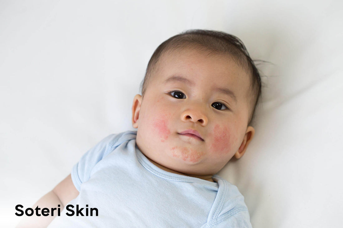 The Ultimate Guide to Baby Rashes: Types, Symptoms, & Prevention Tips
