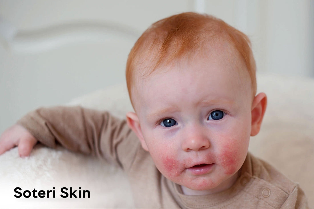 Understanding Psoriasis in Babies