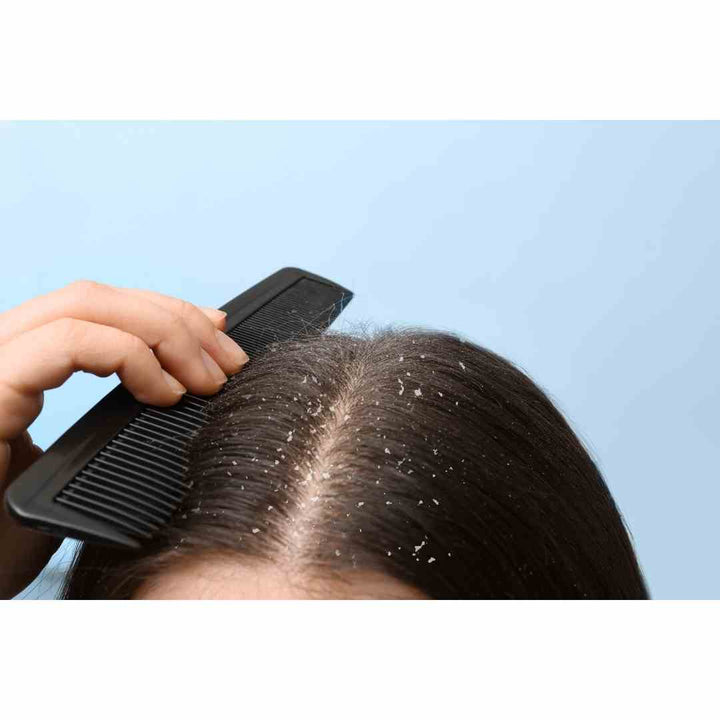 woman with itchy scalp and dandruff holding comb
