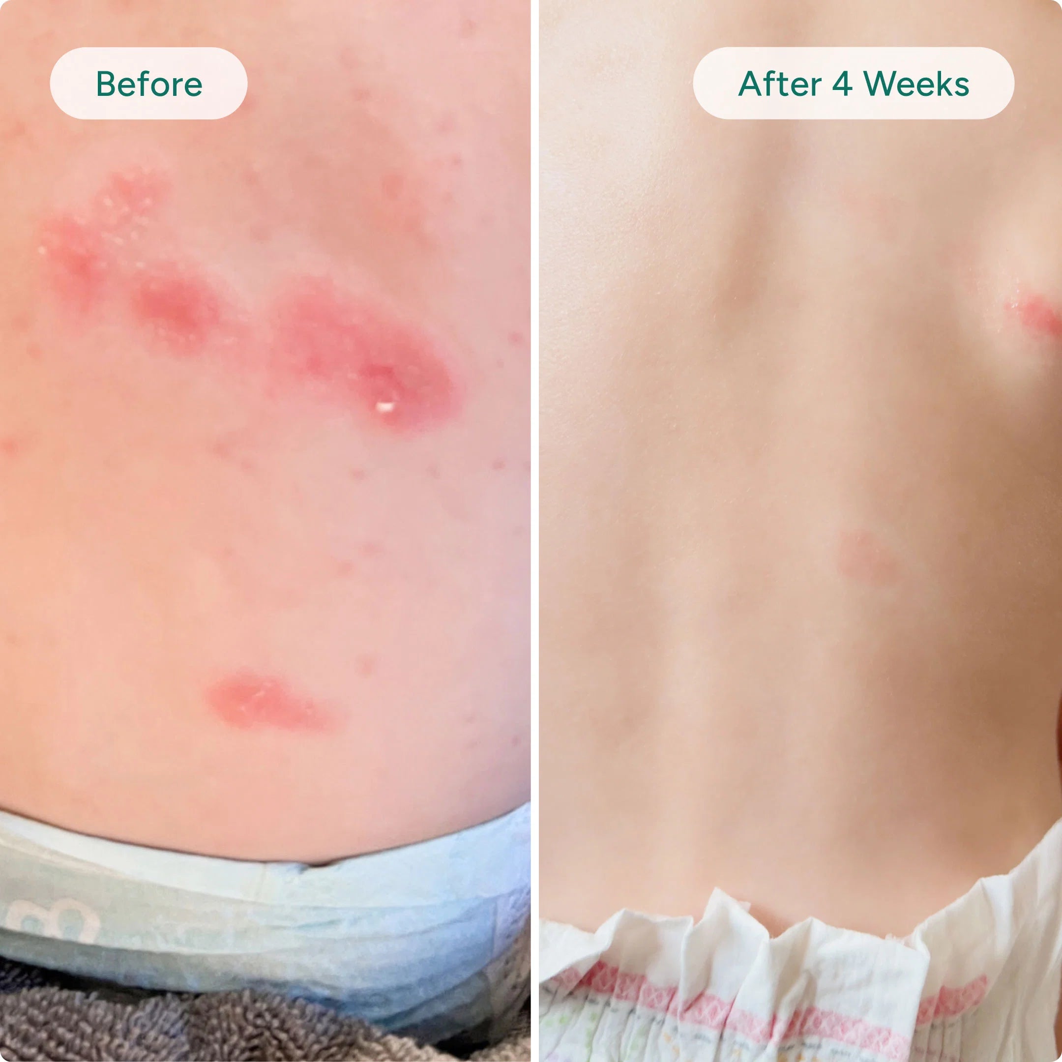 Baby Eczema Relief Cream