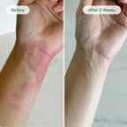 Active Flare-Up Eczema Relief Cream
