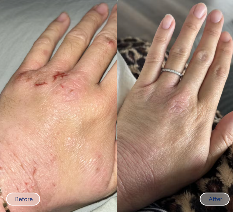 hand eczema before and after