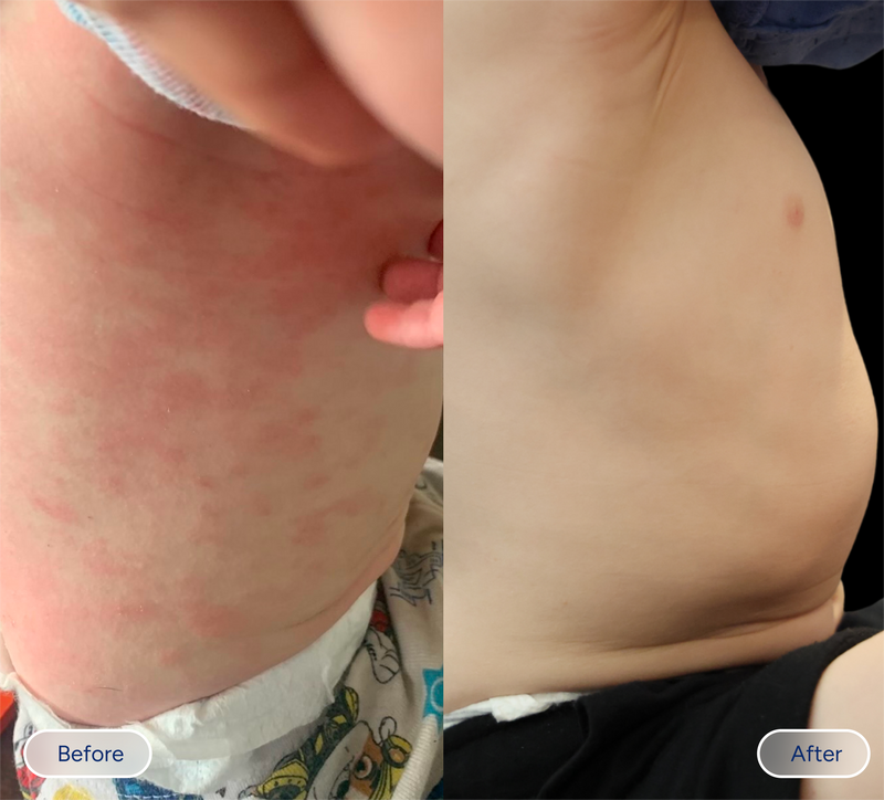 baby eczema before and after