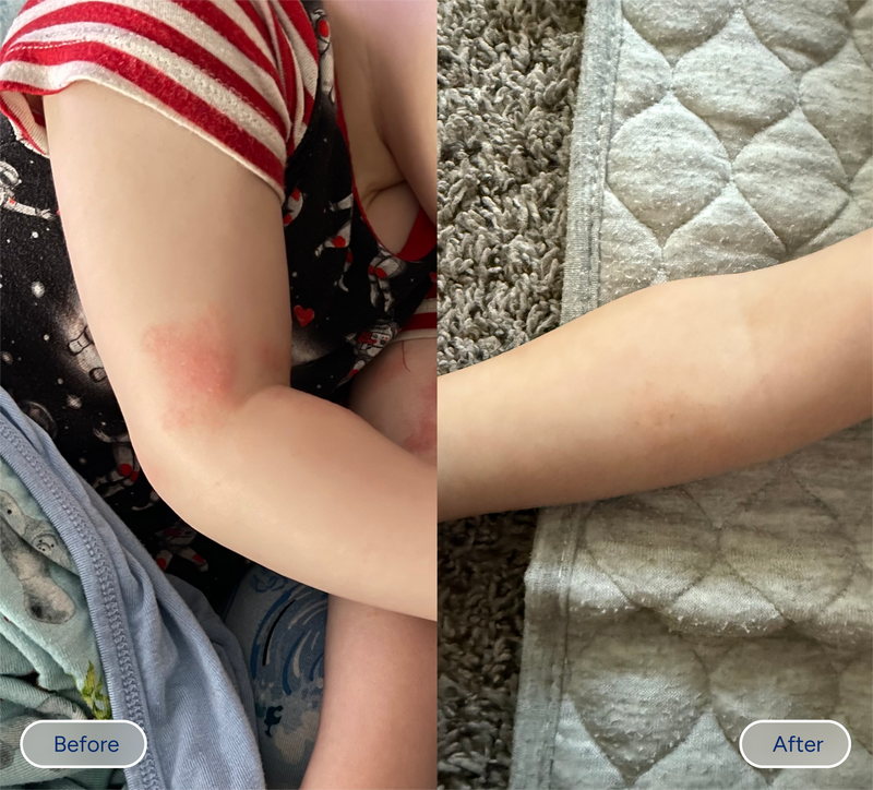 baby eczema before and after