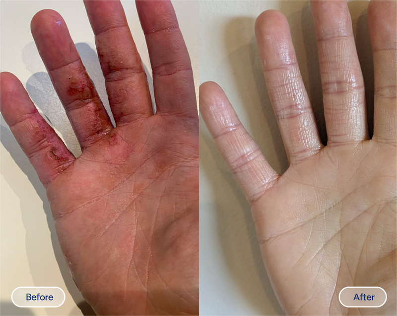 hand eczema before and after