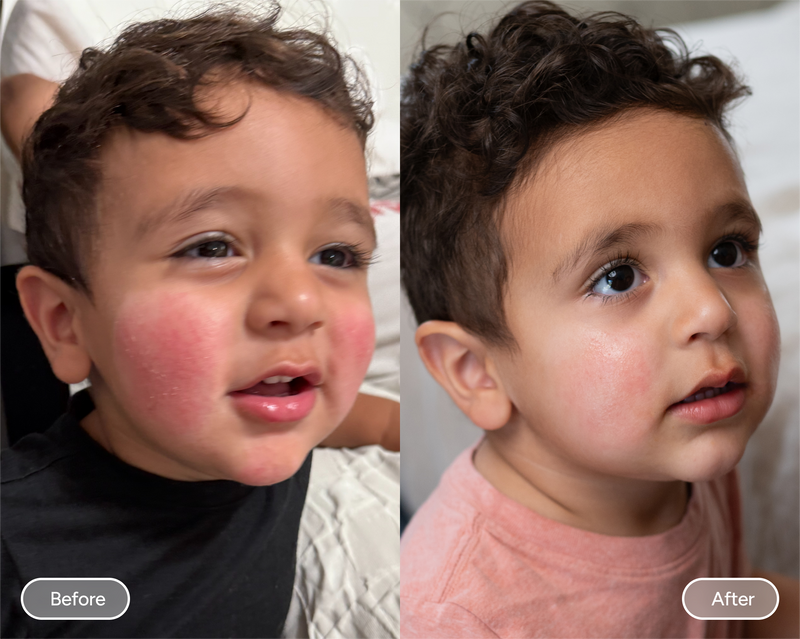 baby face eczema before & after