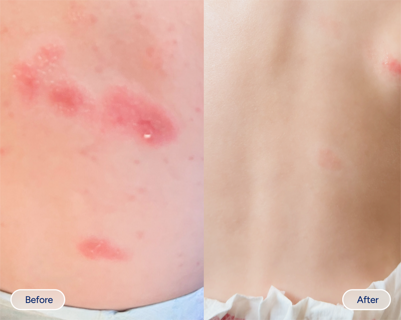 baby eczema before and after