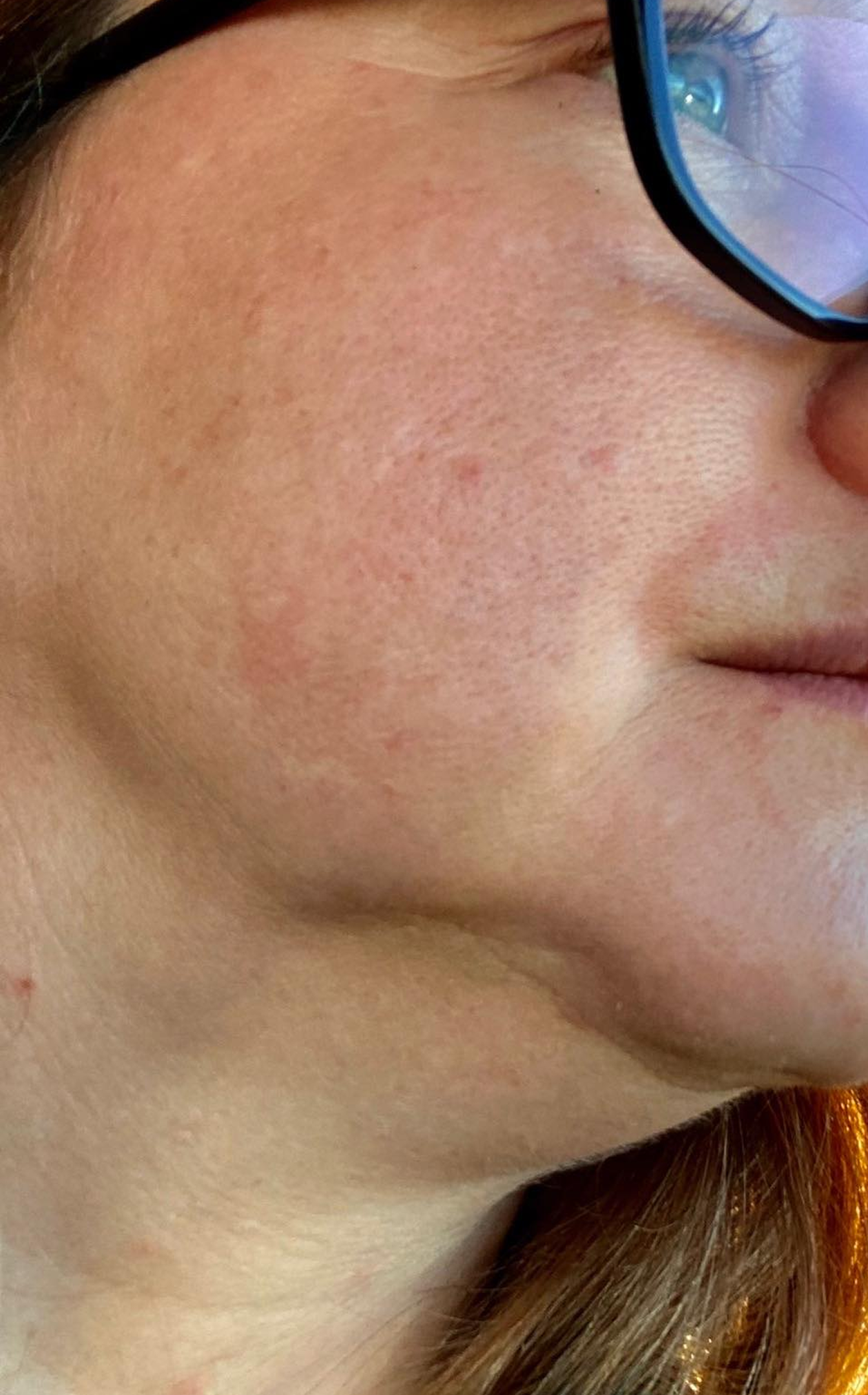 neck  atopic dermatitis before