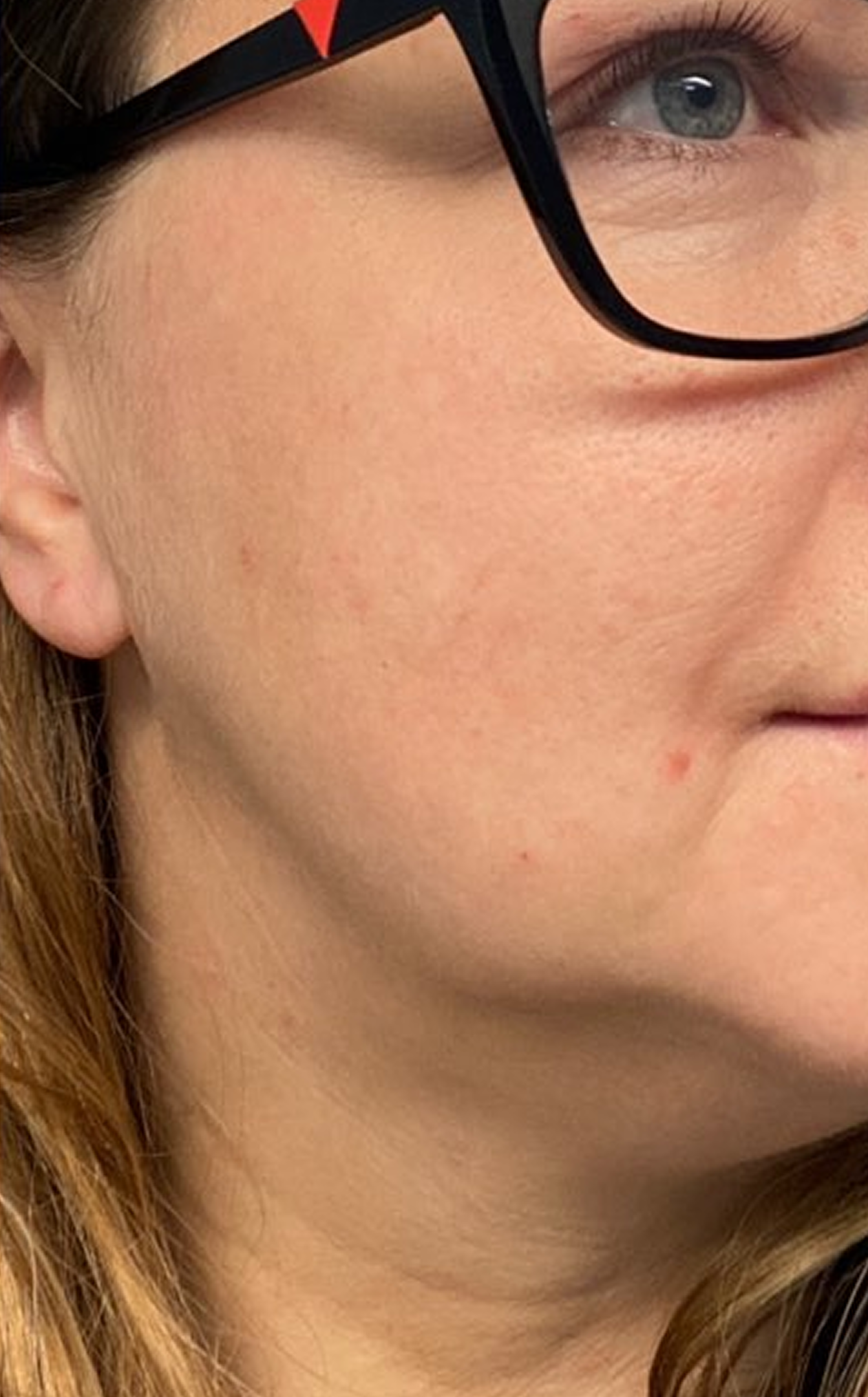 neck  atopic dermatitis after