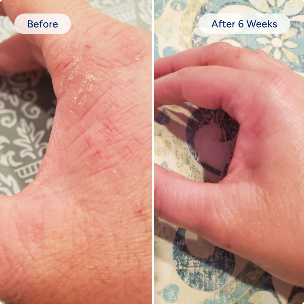 Eczema Relief Kit