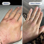 Long-Term Eczema Relief Cream