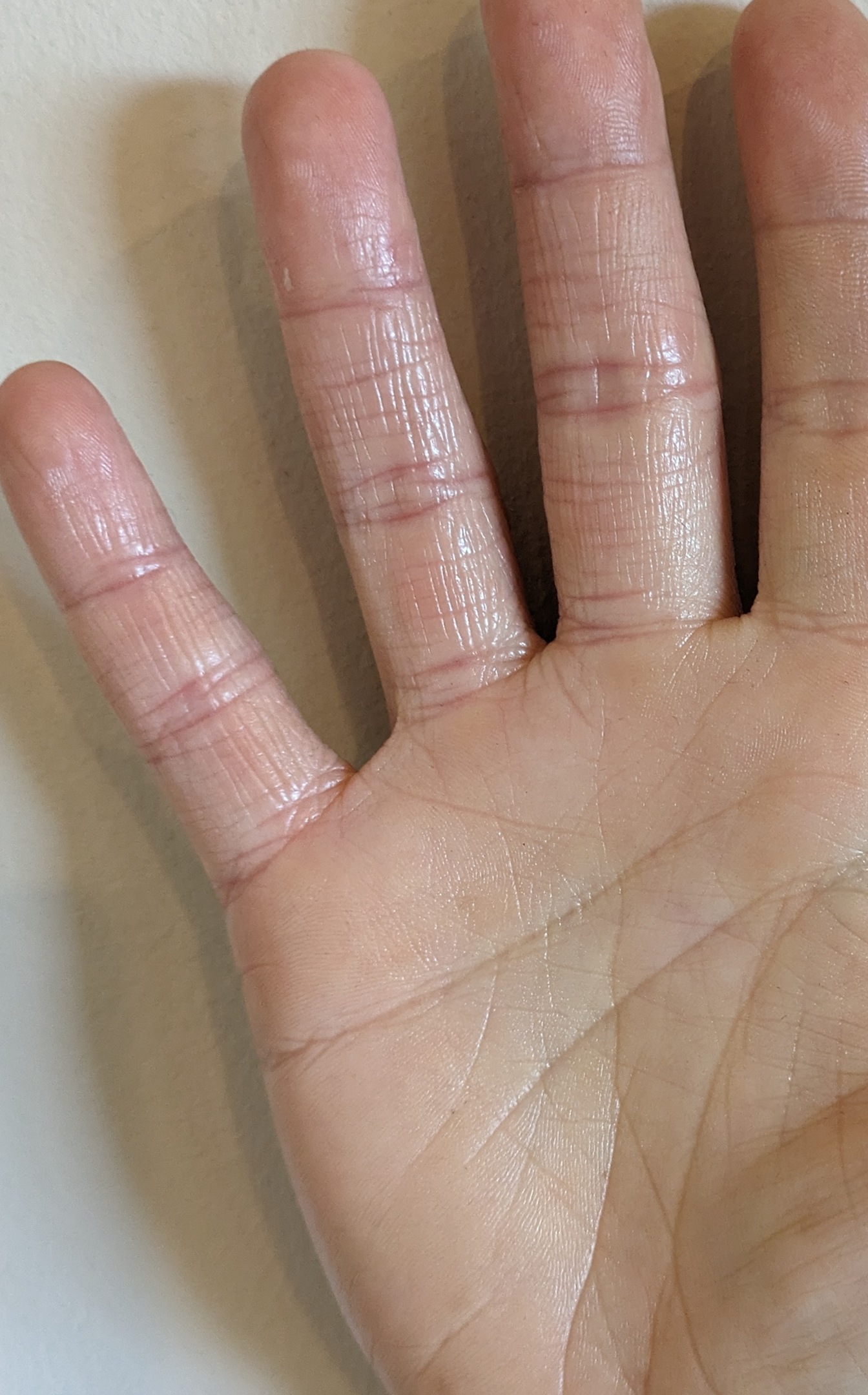 hand eczema after