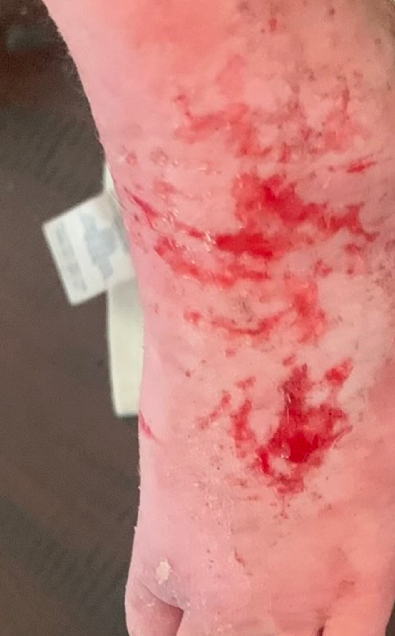 foot atopic dermatitis before