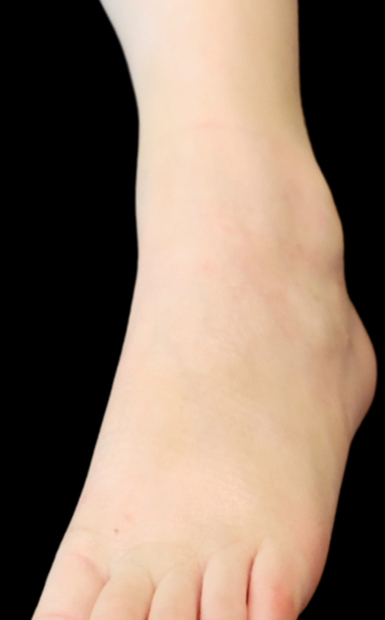foot atopic dermatitis after
