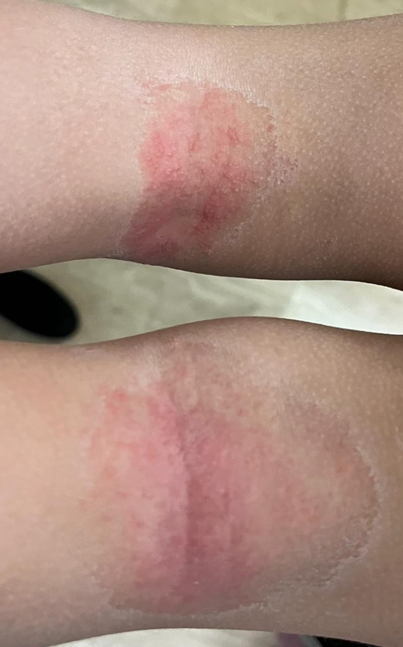 popliteal atopic dermatitis before