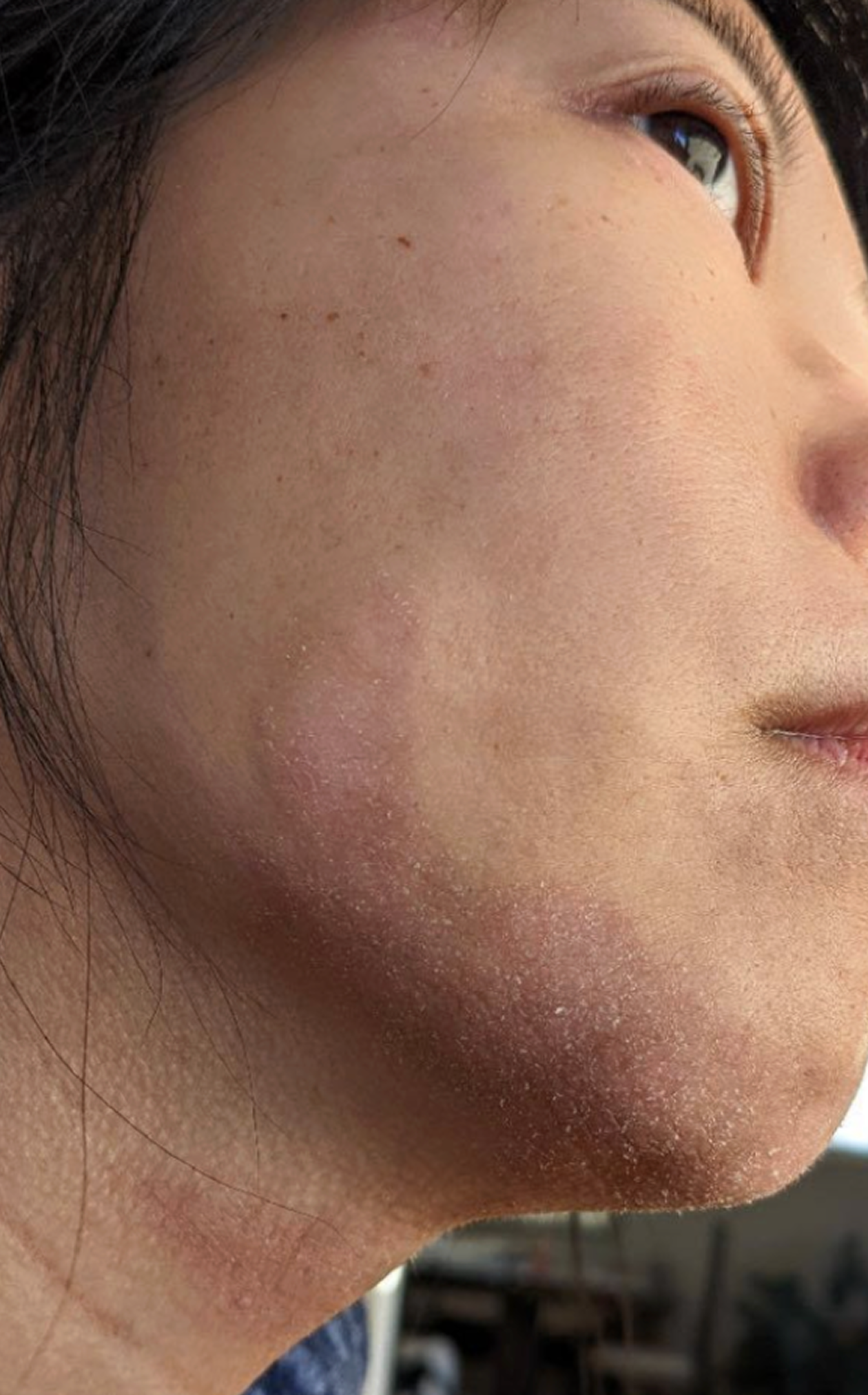 facial atopic dermatitis before