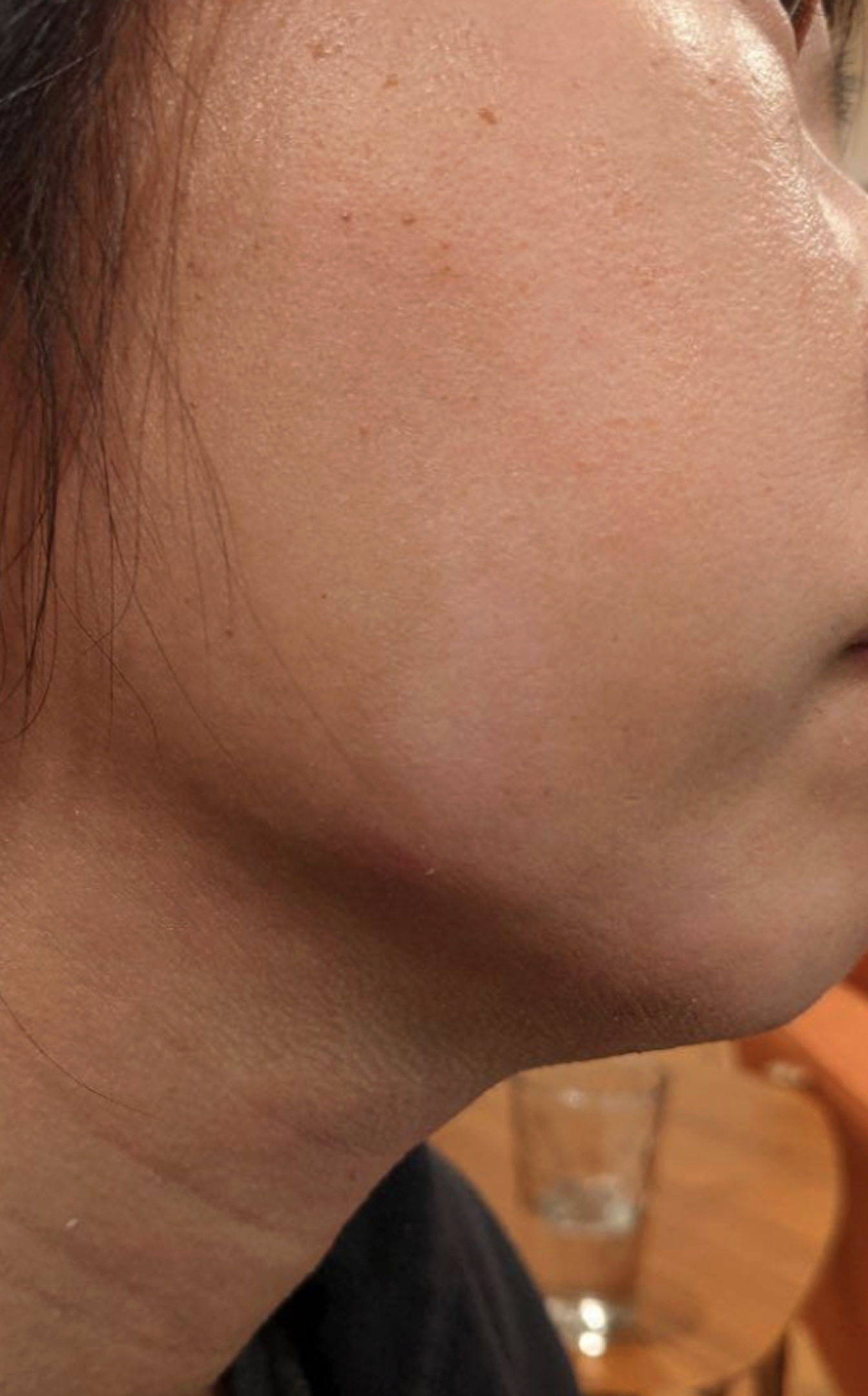 facial atopic dermatitis after