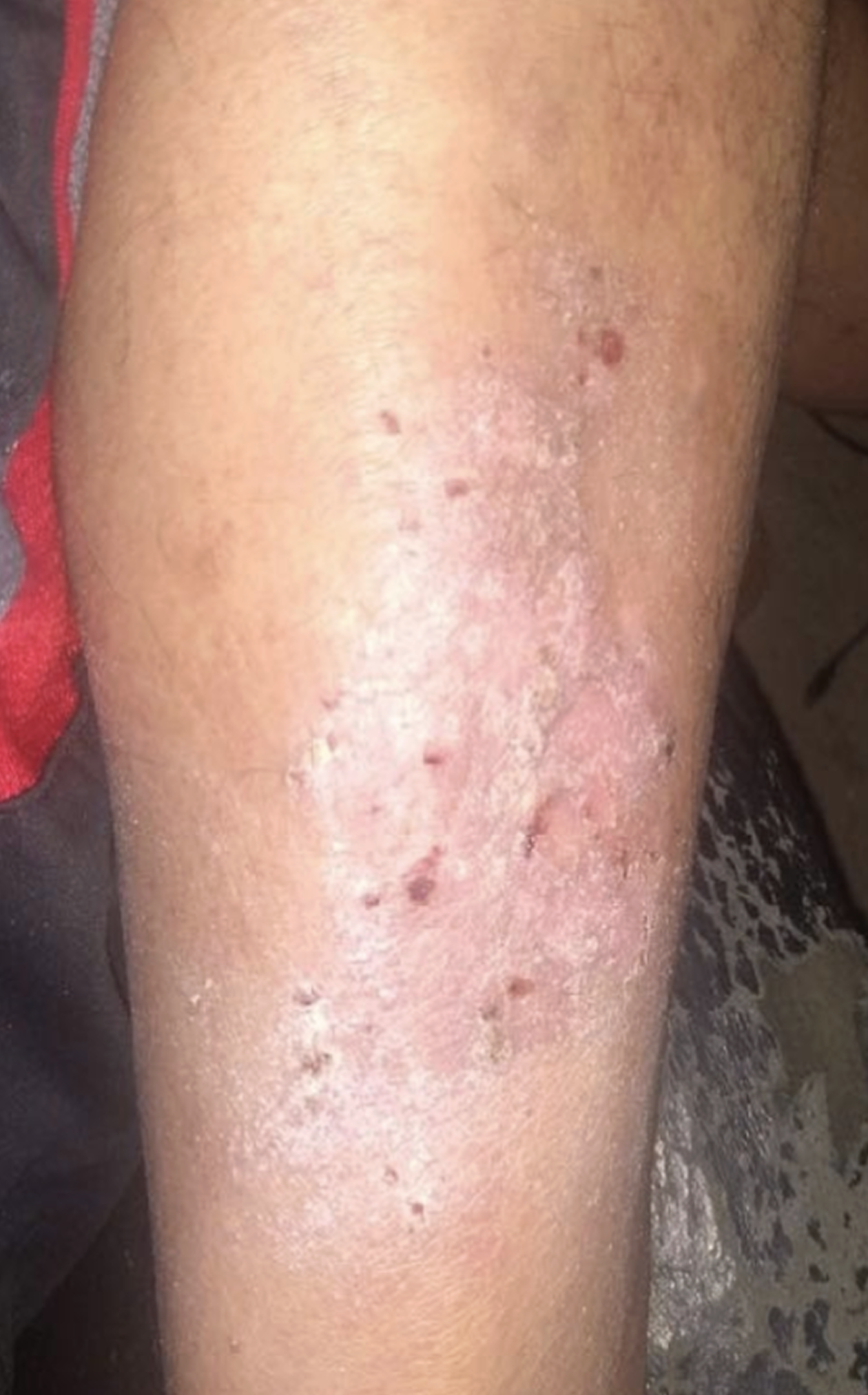 pretibial eczema before