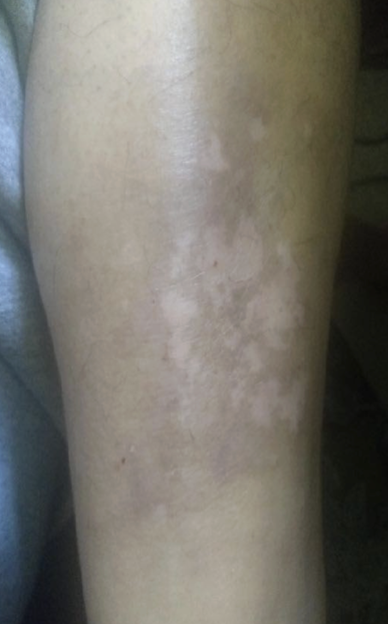 pretibial eczema after