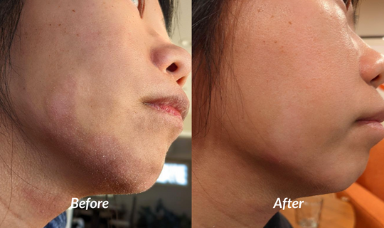 Moderate flaky dry eczema on woman's chin before and after success with soteri skin