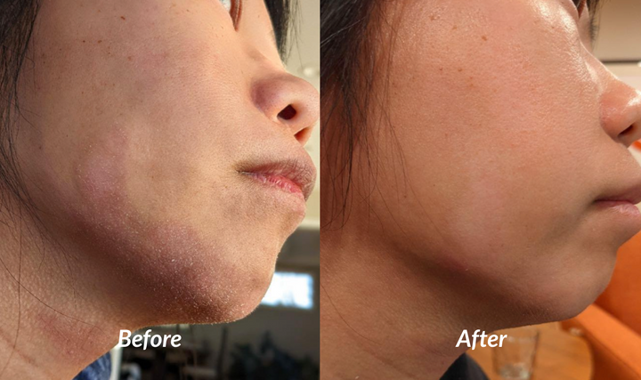 Moderate flaky dry eczema on woman's chin before and after success with soteri skin