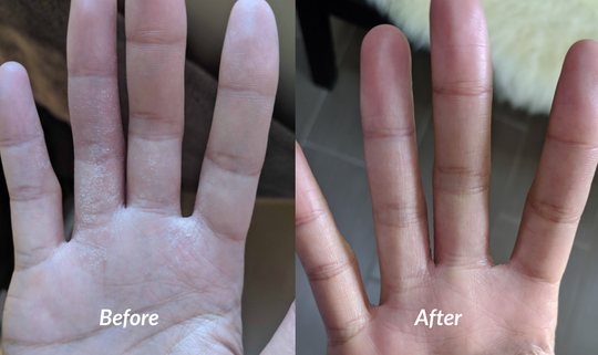 Moderate flaky dry eczema on hands before and after success with soteri skin
