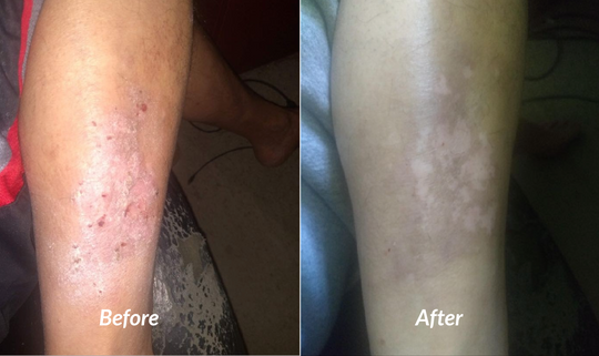 Severe eczema with raw lesions and open sores on male calf or led before and after success