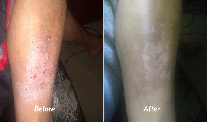 Severe eczema with raw lesions and open sores on male calf or led before and after success