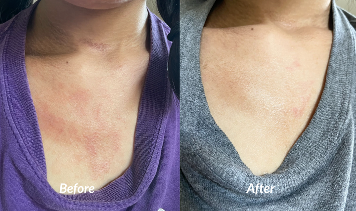 Eczema on chest before and after success